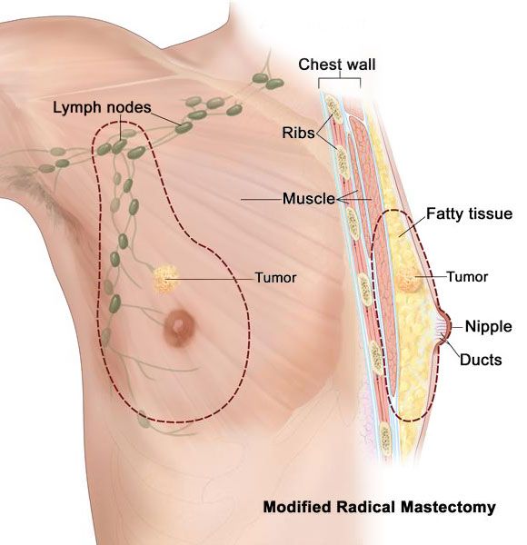 Breast Cancer also found in male