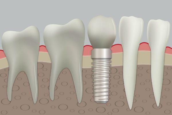 dental implants